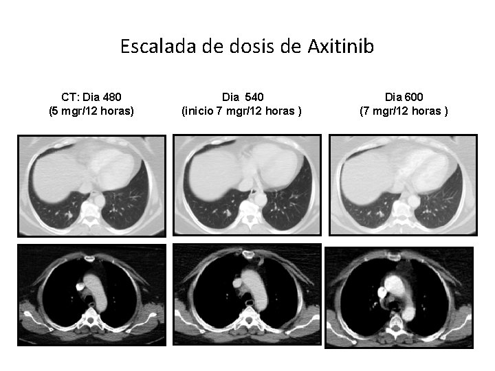 Escalada de dosis de Axitinib CT: Dia 480 (5 mgr/12 horas) Dia 540 (inicio