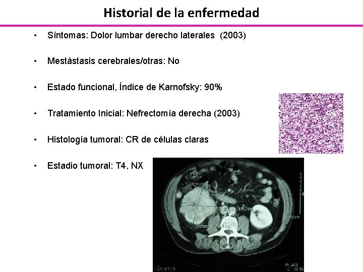 Historial de la enfermedad • Síntomas: Dolor lumbar derecho laterales (2003) • Mestástasis cerebrales/otras: