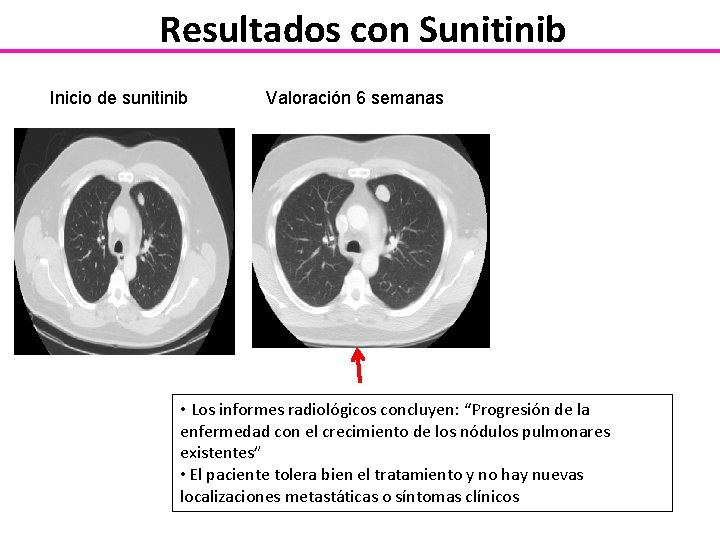 Resultados con Sunitinib Inicio de sunitinib Valoración 6 semanas Sunitinib Best Jan 2010 response