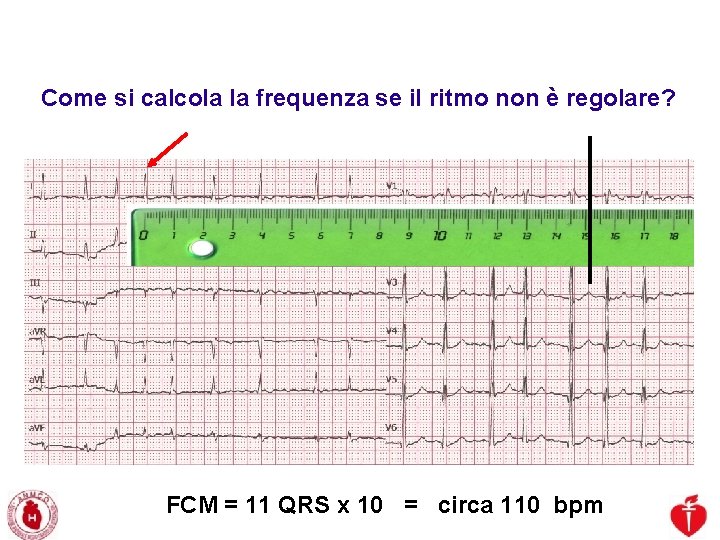 Advanced Cardiac Life Support Gruppo RCP ANMCO - ITO AHA Come si calcola la