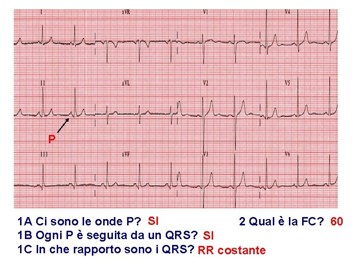 Advanced Cardiac Life Support Gruppo RCP ANMCO - ITO AHA P 1 A Ci