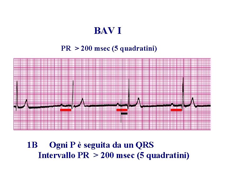 Advanced Cardiac Life Support Gruppo RCP ANMCO - ITO AHA BAV I PR >