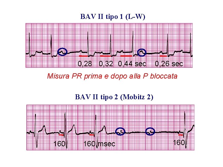 Advanced Cardiac Life Support Gruppo RCP ANMCO - ITO AHA BAV II tipo 1