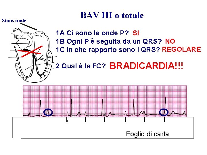 Advanced Cardiac Life Support Gruppo RCP ANMCO - ITO AHA Sinus node BAV III