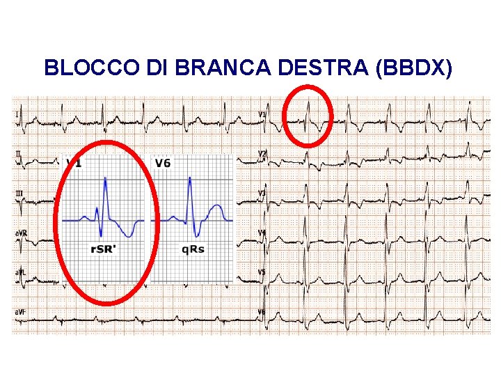 Advanced Cardiac Life Support Gruppo RCP ANMCO - ITO AHA BLOCCO DI BRANCA DESTRA