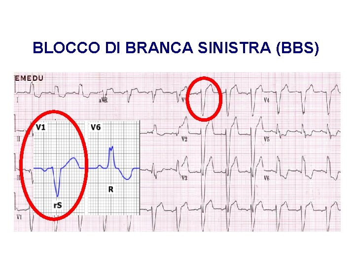 Advanced Cardiac Life Support Gruppo RCP ANMCO - ITO AHA BLOCCO DI BRANCA SINISTRA