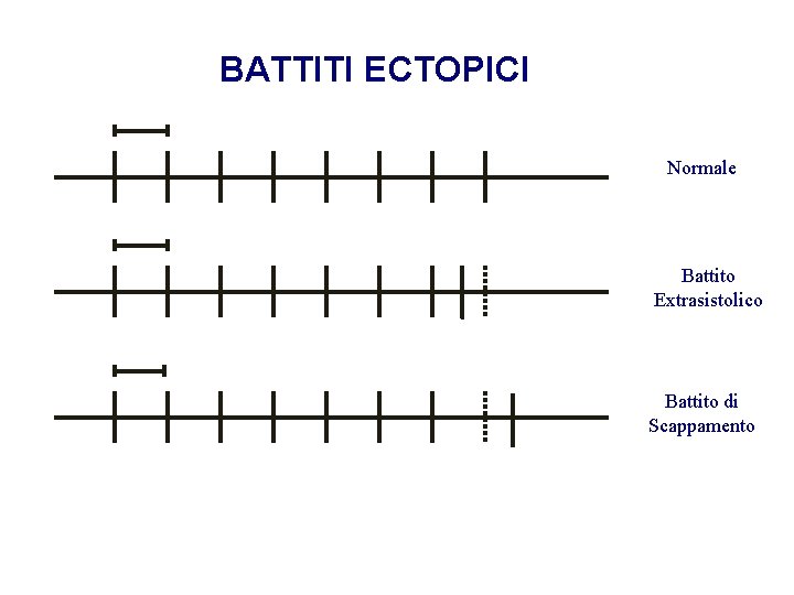 Advanced Cardiac Life Support Gruppo RCP ANMCO - ITO AHA BATTITI ECTOPICI Normale Battito