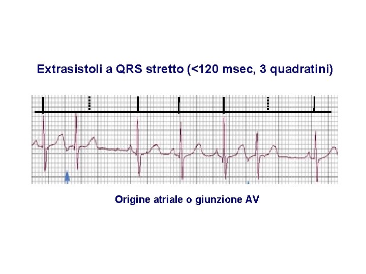 Advanced Cardiac Life Support Gruppo RCP ANMCO - ITO AHA Extrasistoli a QRS stretto