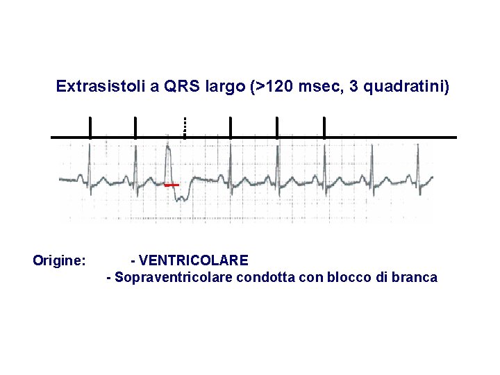 Advanced Cardiac Life Support Gruppo RCP ANMCO - ITO AHA Extrasistoli a QRS largo