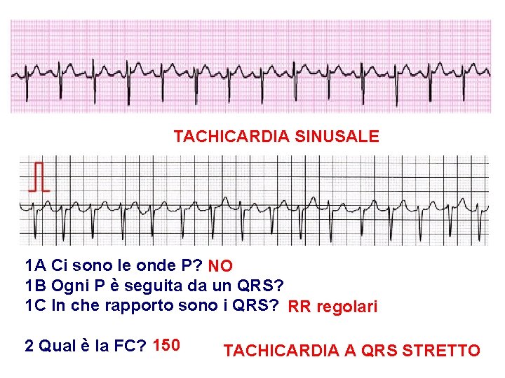 Advanced Cardiac Life Support Gruppo RCP ANMCO - ITO AHA TACHICARDIA SINUSALE 1 A