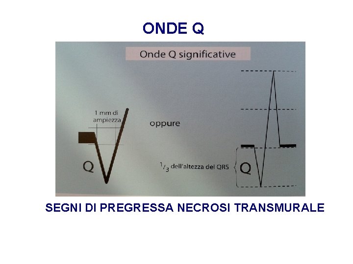 Advanced Cardiac Life Support Gruppo RCP ANMCO - ITO AHA ONDE Q SEGNI DI