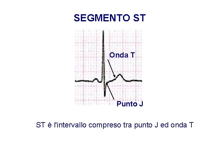 Advanced Cardiac Life Support Gruppo RCP ANMCO - ITO AHA SEGMENTO ST Onda T
