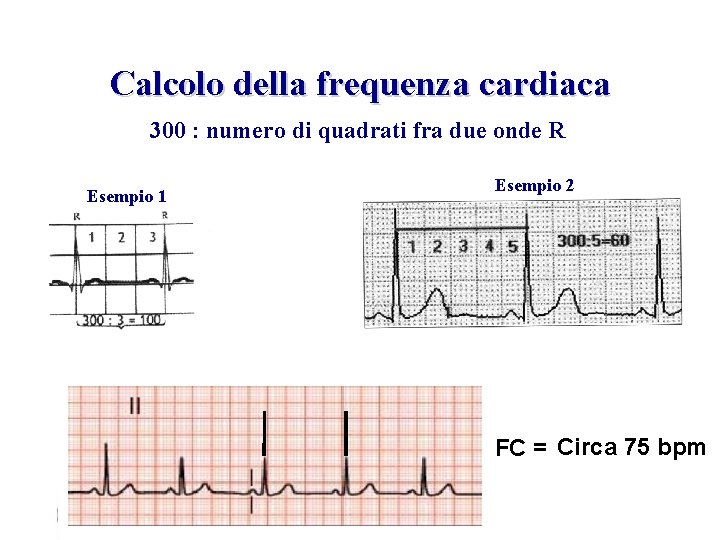 Advanced Cardiac Life Support Gruppo RCP ANMCO - ITO AHA Calcolo della frequenza cardiaca