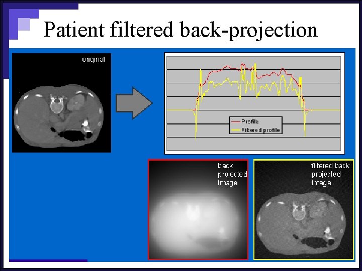 Patient filtered back-projection 