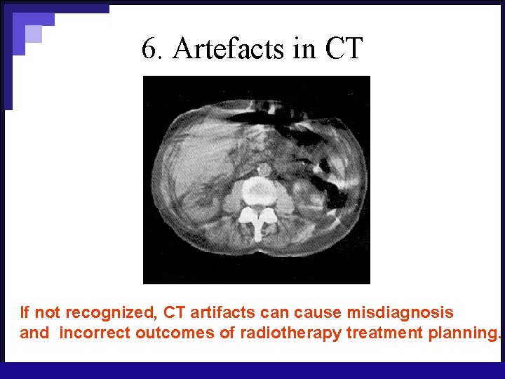 6. Artefacts in CT If not recognized, CT artifacts can cause misdiagnosis and incorrect