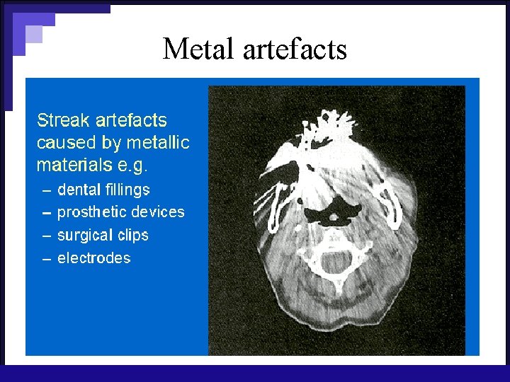 Metal artefacts 