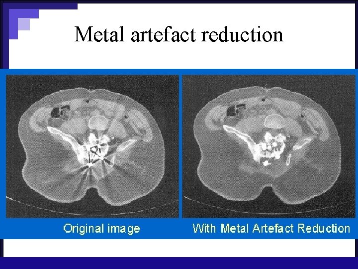 Metal artefact reduction 