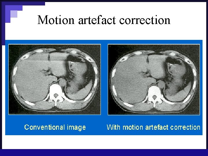 Motion artefact correction 