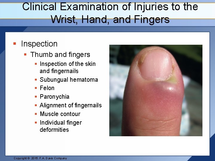 Clinical Examination of Injuries to the Wrist, Hand, and Fingers § Inspection § Thumb