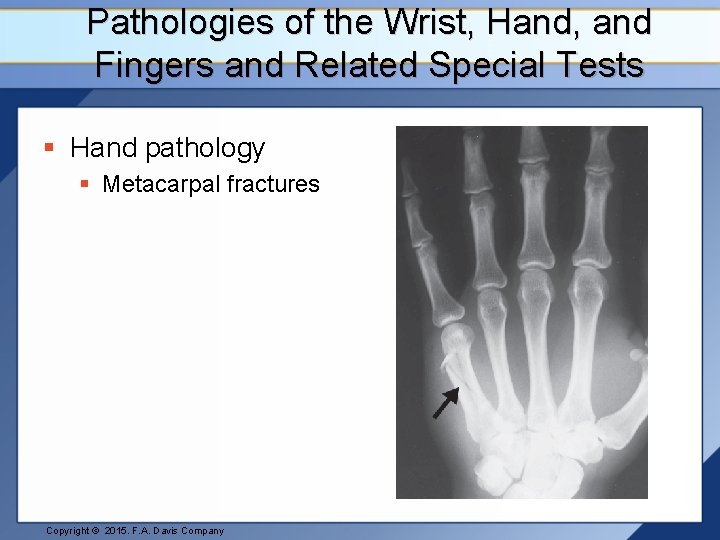 Pathologies of the Wrist, Hand, and Fingers and Related Special Tests § Hand pathology