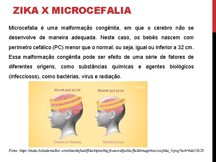 ZIKA X MICROCEFALIA Microcefalia é uma malformação congênita, em que o cérebro não se