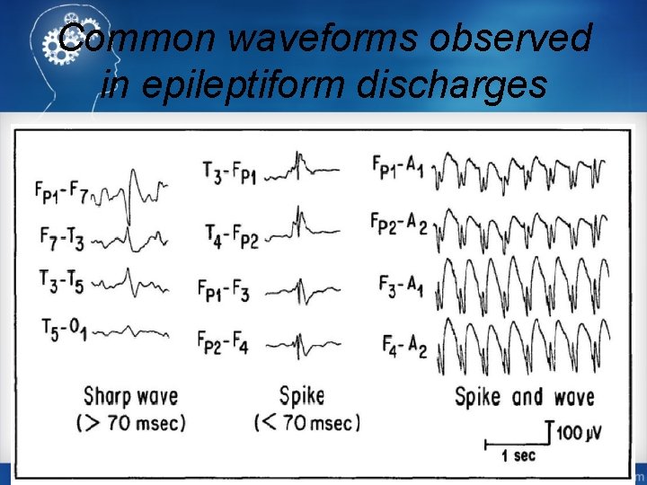 Common waveforms observed in epileptiform discharges 