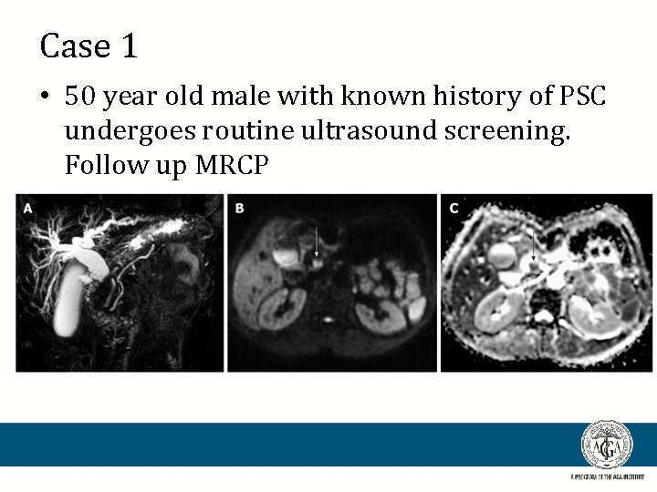 Case 1 • 50 year old male with known history of PSC undergoes routine