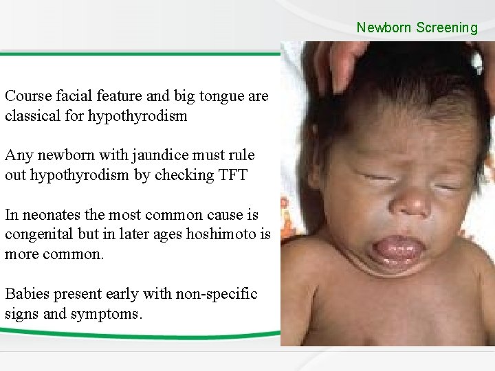 Newborn Screening Course facial feature and big tongue are classical for hypothyrodism Any newborn Newborn Screening Course facial feature and big tongue are classical for hypothyrodism Any newborn