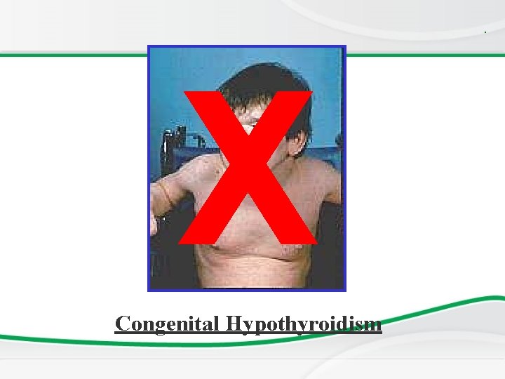 . X Congenital Hypothyroidism . X Congenital Hypothyroidism