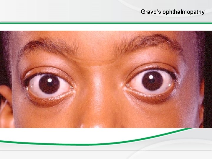 Grave’s ophthalmopathy Grave’s ophthalmopathy