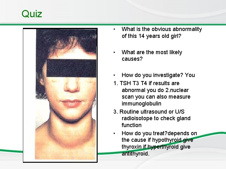 Quiz • What is the obvious abnormality of this 14 years old girl? • Quiz • What is the obvious abnormality of this 14 years old girl? •