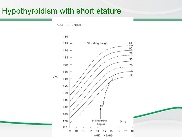 Hypothyroidism with short stature Hypothyroidism with short stature