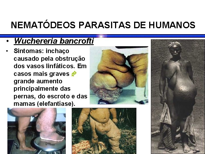 NEMATÓDEOS PARASITAS DE HUMANOS • Wuchereria bancrofti • Sintomas: inchaço causado pela obstrução dos NEMATÓDEOS PARASITAS DE HUMANOS • Wuchereria bancrofti • Sintomas: inchaço causado pela obstrução dos