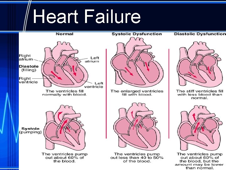 Heart Failure 