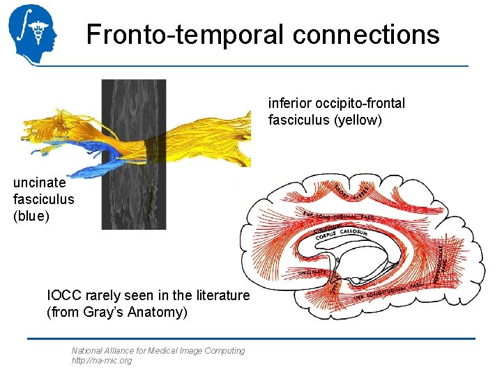 Fronto-temporal connections inferior occipito-frontal fasciculus (yellow) uncinate fasciculus (blue) IOCC rarely seen in the