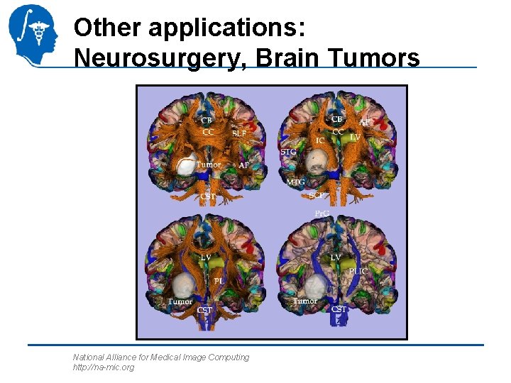 Other applications: Neurosurgery, Brain Tumors National Alliance for Medical Image Computing http: //na-mic. org