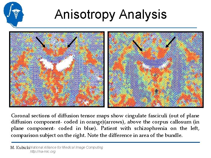 Anisotropy Analysis Coronal sections of diffusion tensor maps show cingulate fasciculi (out of plane