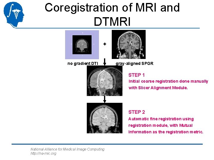 Coregistration of MRI and DTMRI + no gradient DTI gray-aligned SPGR STEP 1 Initial