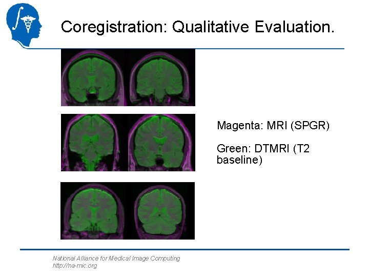 Coregistration: Qualitative Evaluation. Magenta: MRI (SPGR) Green: DTMRI (T 2 baseline) National Alliance for