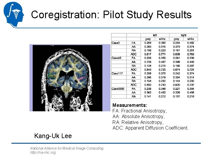 Coregistration: Pilot Study Results Measurements: FA: Fractional Anisotropy, AA: Absolute Anisotropy, RA: Relative Anisotropy,