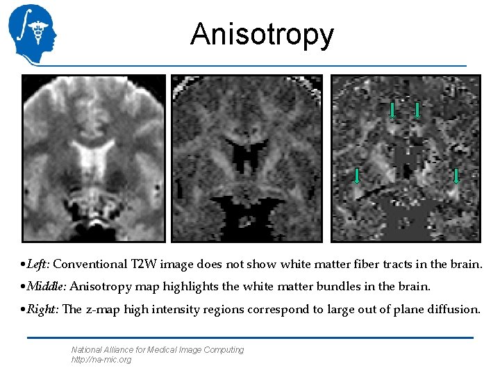 Anisotropy • Left: Conventional T 2 W image does not show white matter fiber