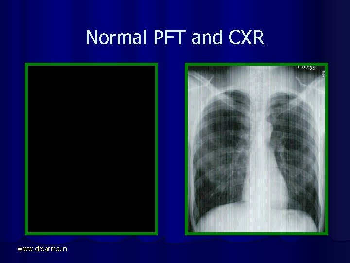 Normal PFT and CXR www. drsarma. in 