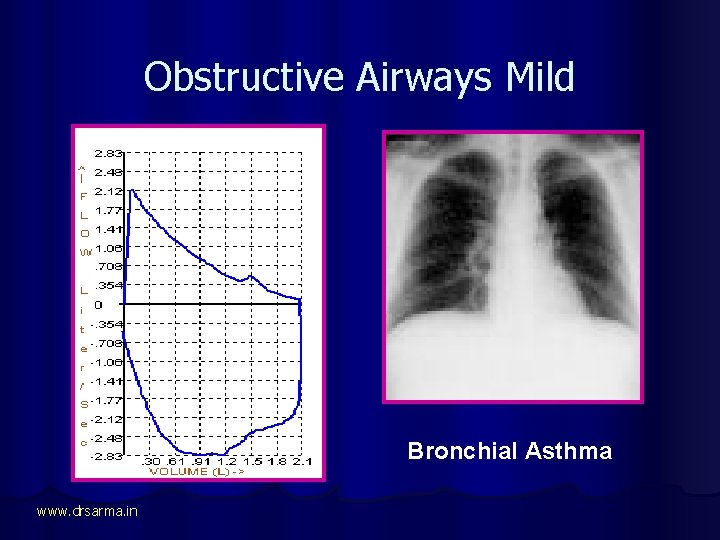 Obstructive Airways Mild Bronchial Asthma www. drsarma. in 