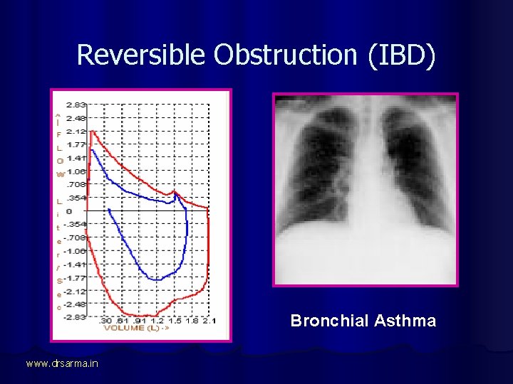 Reversible Obstruction (IBD) Bronchial Asthma www. drsarma. in 