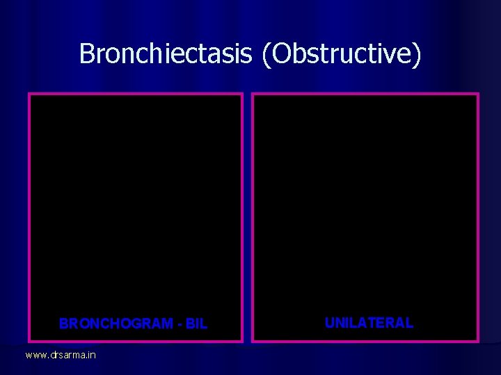 Bronchiectasis (Obstructive) BRONCHOGRAM - BIL www. drsarma. in UNILATERAL 