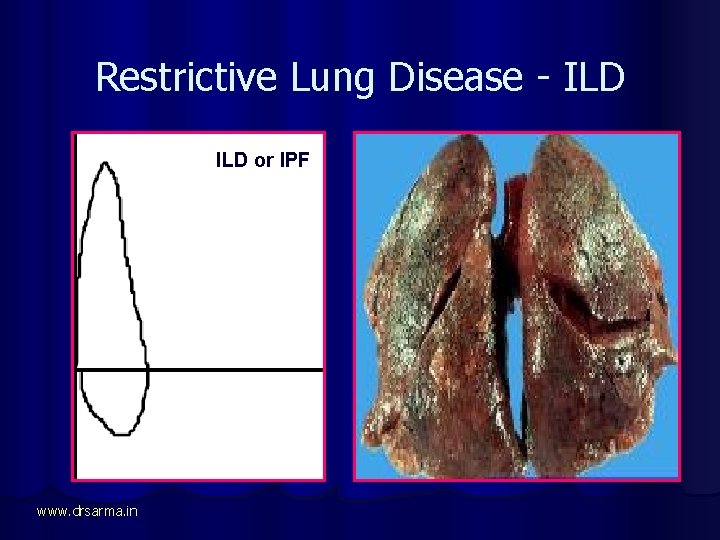 Restrictive Lung Disease - ILD or IPF www. drsarma. in 