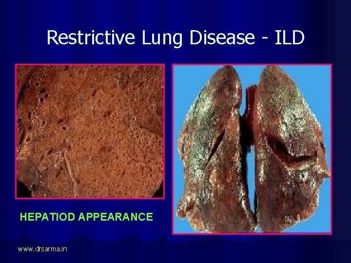 Restrictive Lung Disease - ILD HEPATIOD APPEARANCE www. drsarma. in 