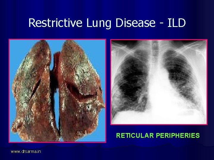 Restrictive Lung Disease - ILD RETICULAR PERIPHERIES www. drsarma. in 