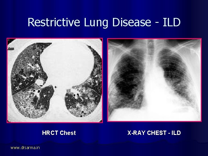 Restrictive Lung Disease - ILD HRCT Chest www. drsarma. in X-RAY CHEST - ILD