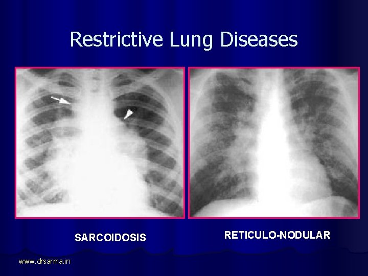 Restrictive Lung Diseases SARCOIDOSIS www. drsarma. in RETICULO-NODULAR 